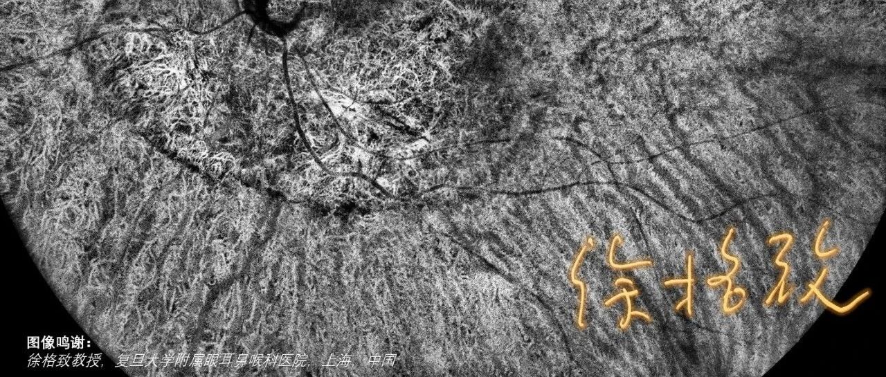 拓展广度和深度，展现OCTA未至之境——脉络膜骨瘤（脉络膜中血管层）