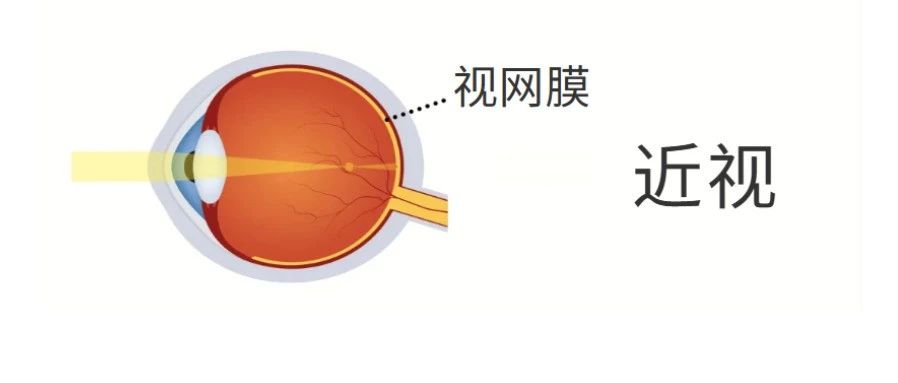 近视防控| “度数一直涨，反正控制不好，以后做近视手术就行了？”