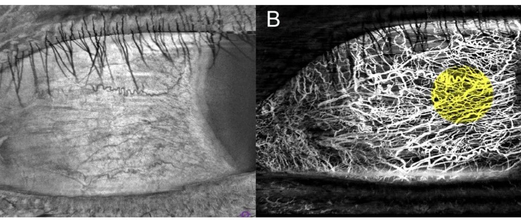 系统性红斑狼疮患者的微血管“警报”——结膜与视网膜的秘密