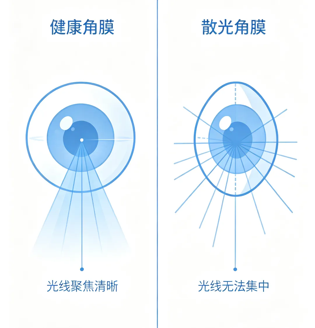 健康角膜与散光角膜对比图（3_4）.png